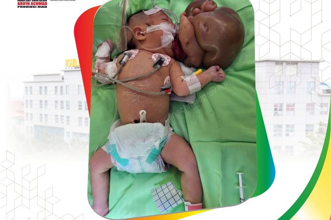 RSUD Arifin Achmad Provinsi Riau Berhasil Lakukan Operasi Pemisahan Bayi Kembar Siam
